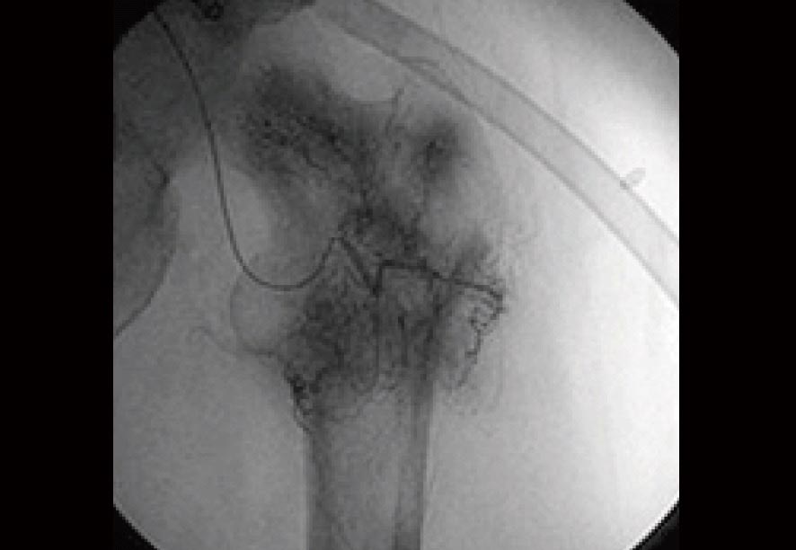 大腿骨にがんの新生血管が認められたX線画像