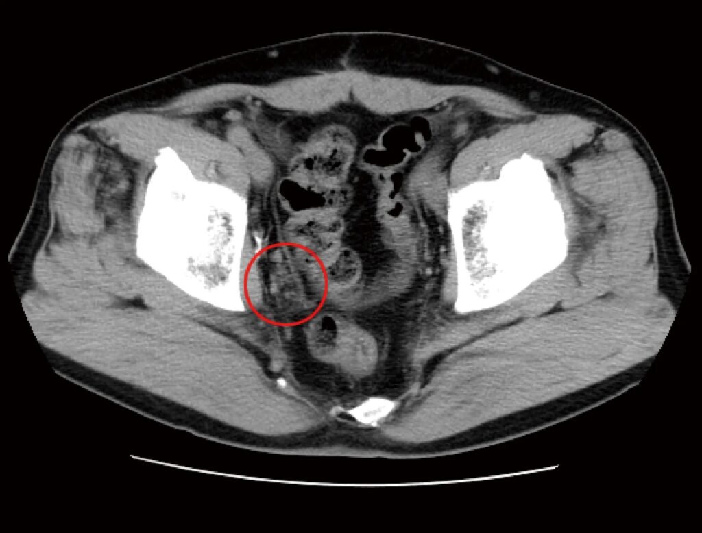 前立腺がんリンパ節に転移したCT画像